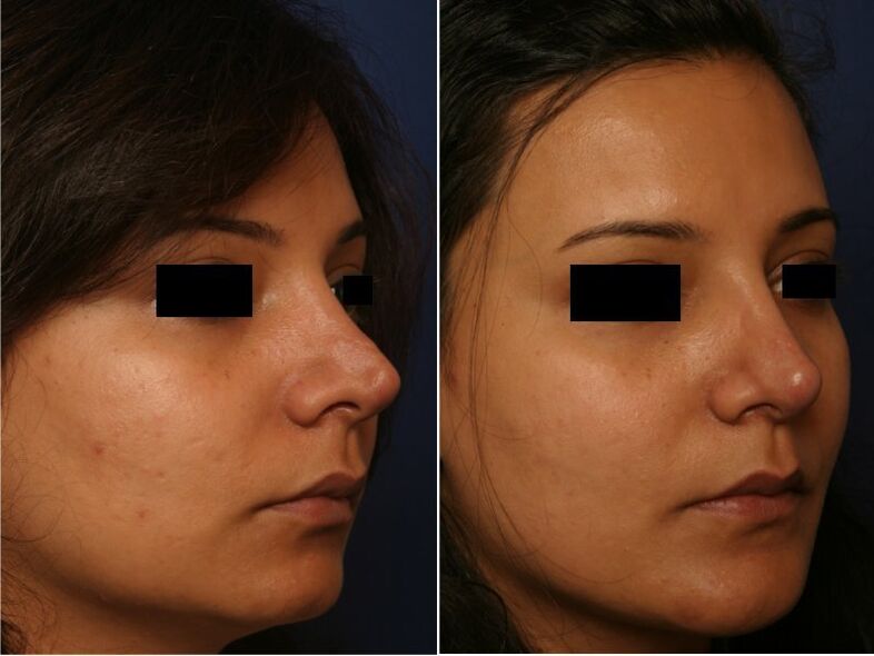 rezultat al unei intervenții chirurgicale plastice