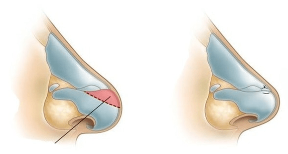 Corectarea formei nasului