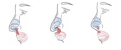 Trunchierea unei părți a mușchiului nazal