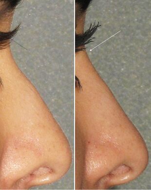 Înainte și după rinoplastia nechirurgicală