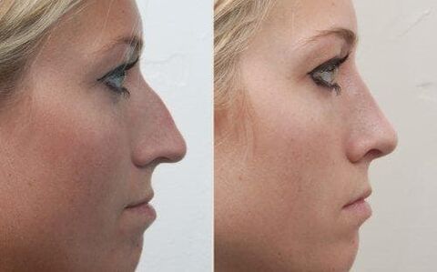 Înainte și după rinoplastia nechirurgicală
