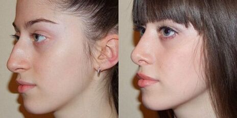 fotografii înainte și după rinoplastia nasului
