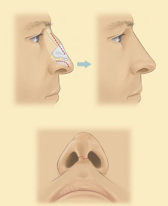 schema pentru rinoplastia nasului