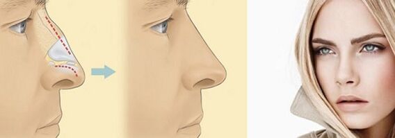 corectarea formei nasului cu rinoplastie non-chirurgicală