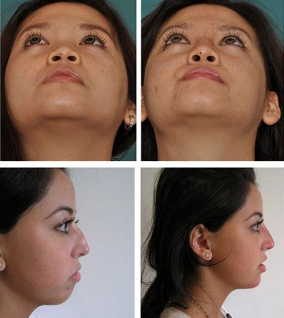 fotografii înainte și după rinoplastie fără intervenție chirurgicală