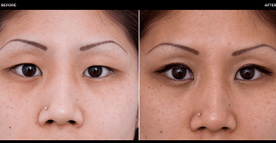 înainte și după operația oculară