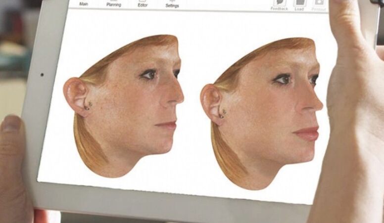 Metoda de modelare computerizată a nasului înainte de rinoplastie