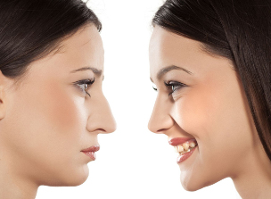 Rinoplastia nasului, înainte și după