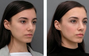 O fată înainte și după rinoplastie la nas