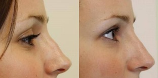 vârful nasului, înainte și după